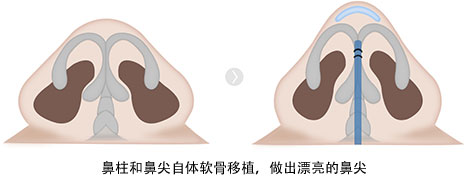 鼻柱和鼻尖自体软骨移植，做出漂亮的鼻尖