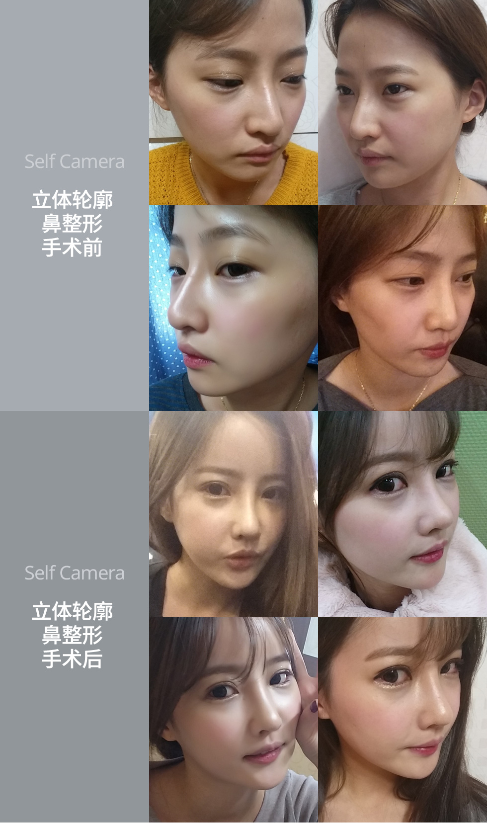 树立面部的中心 立体轮廓鼻整形手术