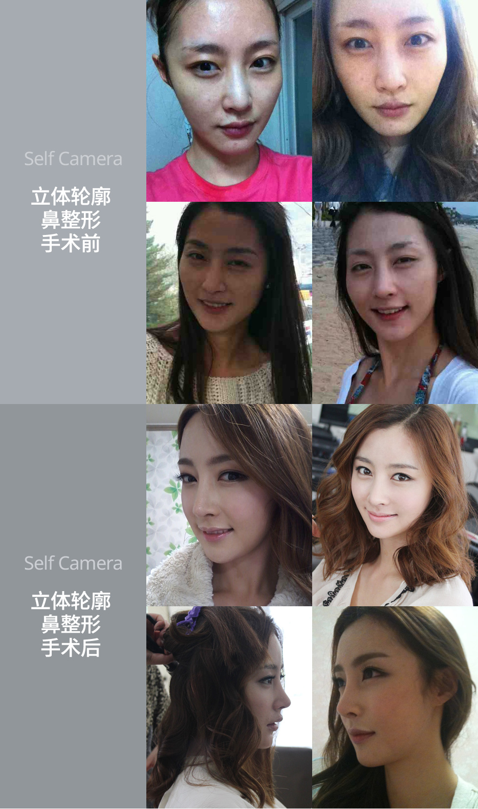 树立面部的中心 立体轮廓鼻整形手术