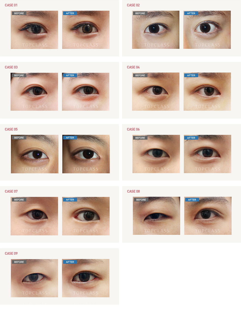 魔力开前眼角（开上眼角）手术前/后