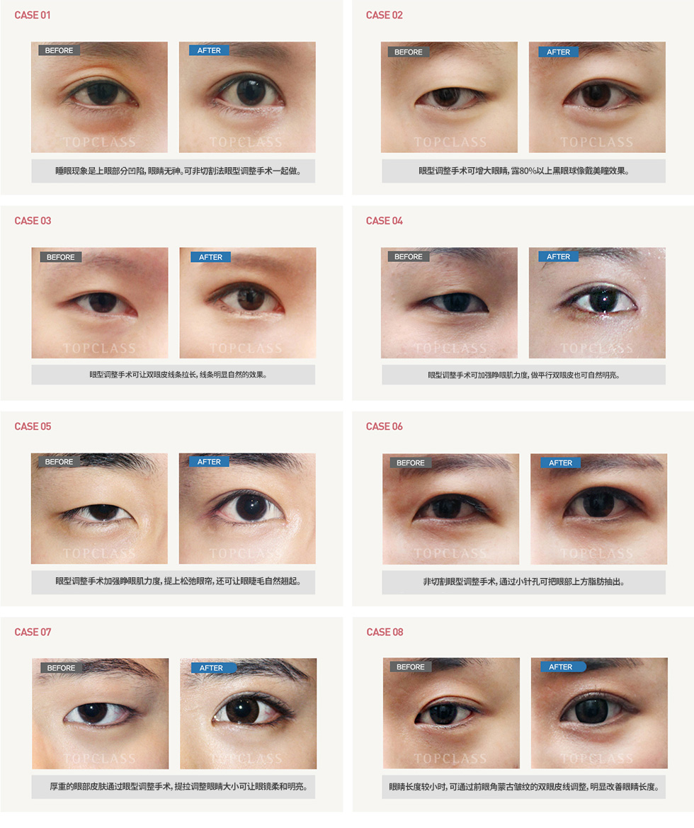 非切开法眼型矫正术手术前/后