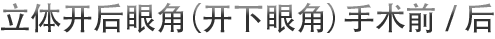 立体开后眼角（开下眼角）手术前/后