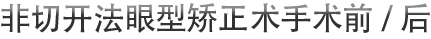 非切开法眼型矫正术手术前/后
