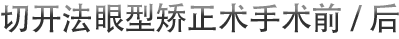 切开法眼型矫正术手术前/后
