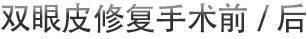 双眼皮修复手术前/后