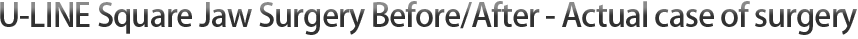 U-LINE Square Jaw Surgery Before/After - Actual case of surgery