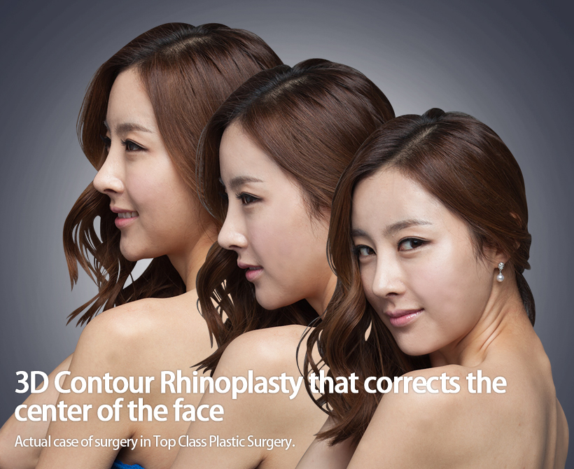 建立端正的面部中心的立体轮廓鼻部整形手术 本院实际手术案例