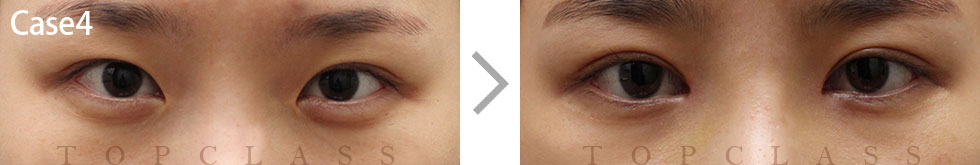 Case4 Magic Inner Corner Fold Removal（Canthoplasty）Before/After