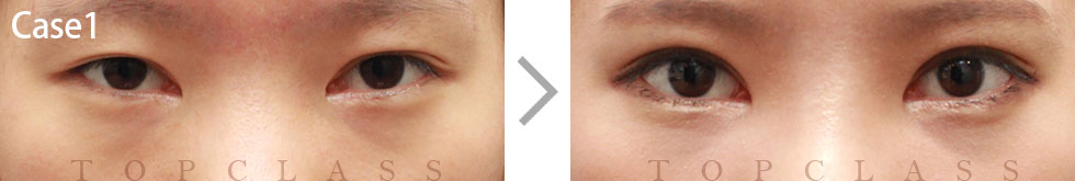 Case1 Multi Outer Corner Extension（Lateral Canthoplasty）Before/After
