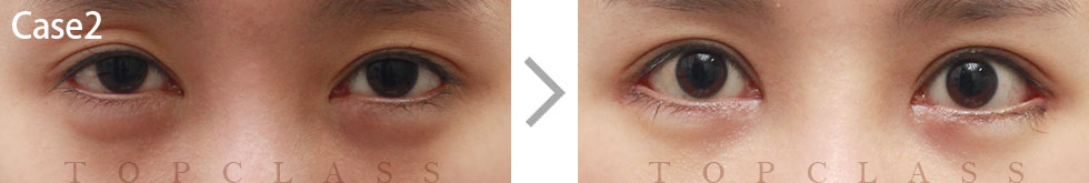 Case2 Multi Outer Corner Extension（Lateral Canthoplasty）Before/After
