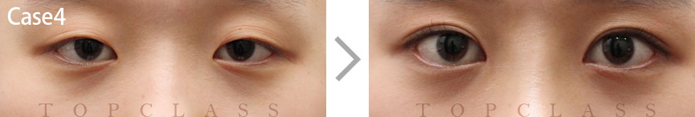 Case4 Incisional Ptosis Surgery Before/After