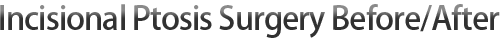 Incisional Ptosis Surgery Before/After