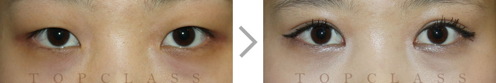 Suture Technique Before/After